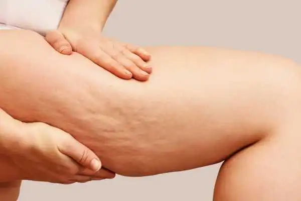 Image of woman showing leg with cellulite Elgin