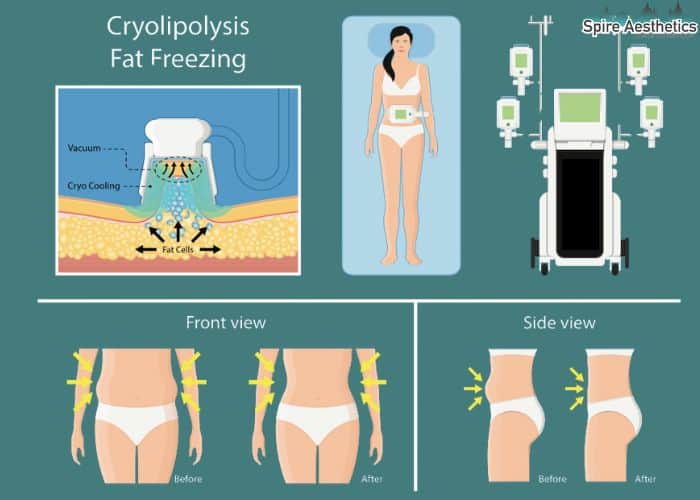 Image of diet and fat freezing combined for best results for Spire Aesthetics Elgin