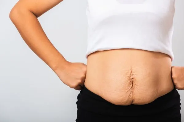 Image of a woman's stomach after weight loss with sagging skin following a gastric band Elgin