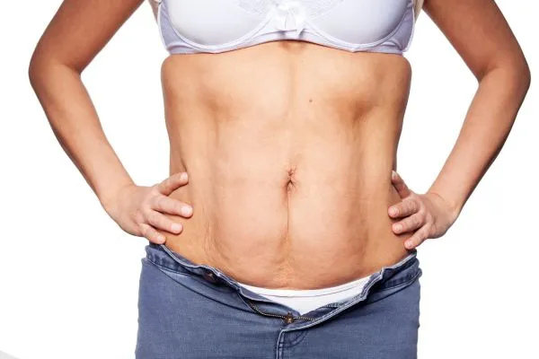 sagging skin on woman's stomach after weight loss injections Elgin