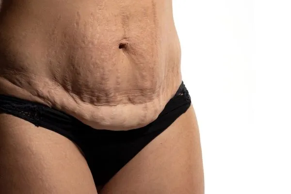 Image of womans stomach after weight loss injections Elgin showing saggy skin