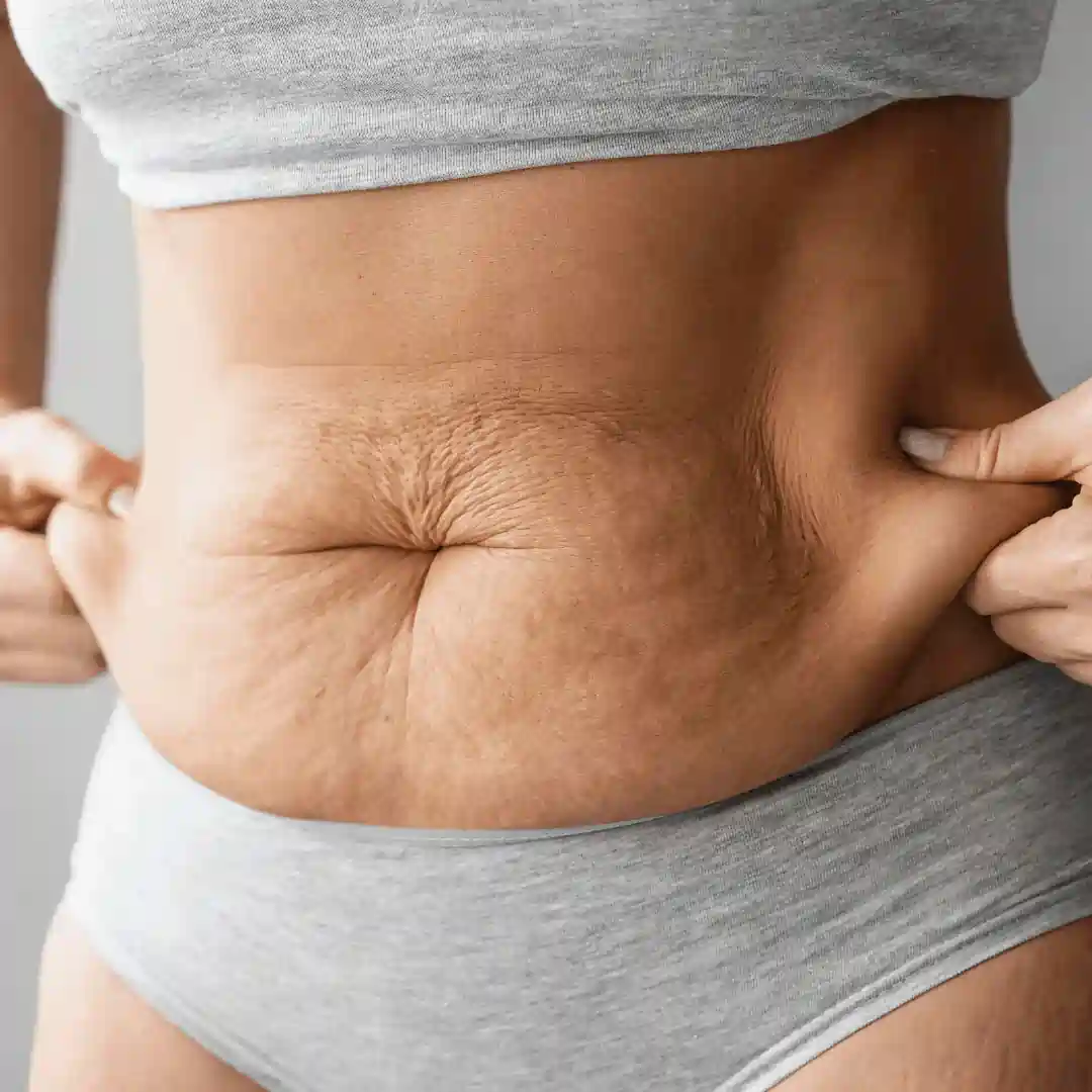 Is It Normal to Have Loose Skin After Pregnancy Elgin?
